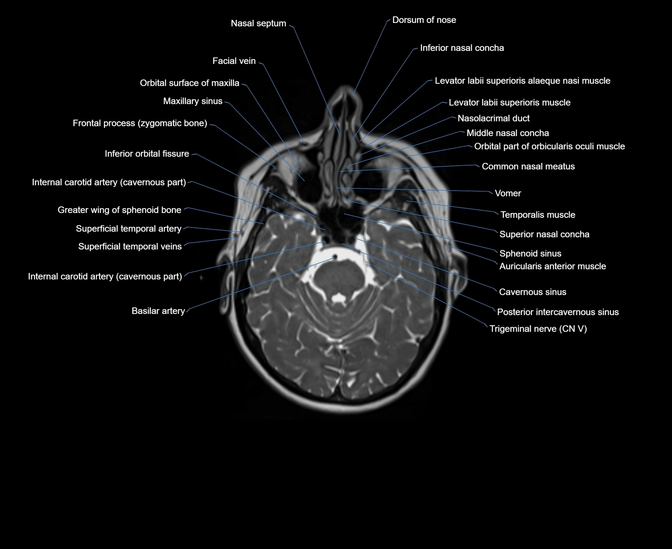 MRI Neck 3D labelled cross section anatomy axial 3t image-00001-00004.webp